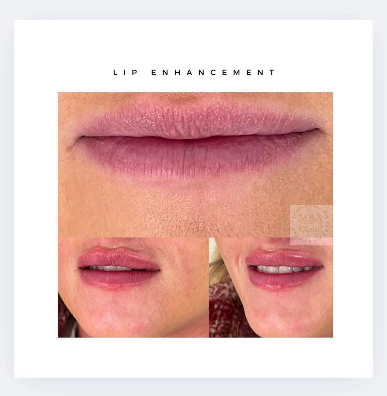 Lip filler at MA SALONS