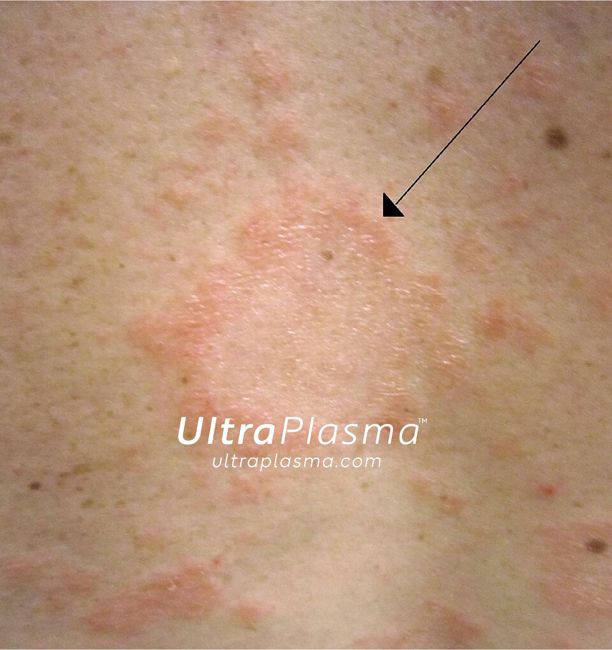 ultraplasma.com_Pityriasis_Rosea_treatment_ultra_plasma_ultra_plazma