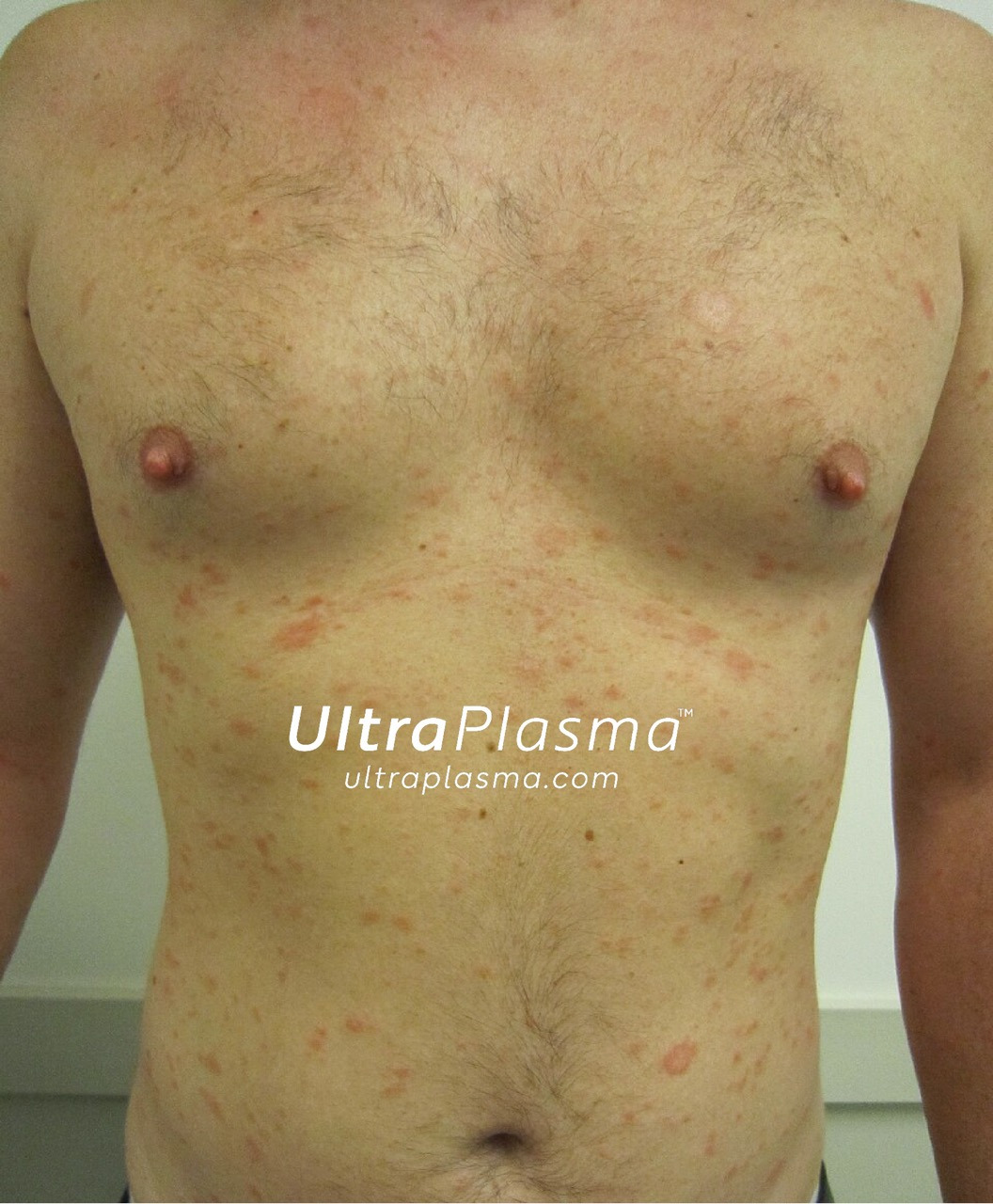 ultraplasma.com_Pityriasis_Rosea_treatment_ultra_plasma_ultra_plazma_1
