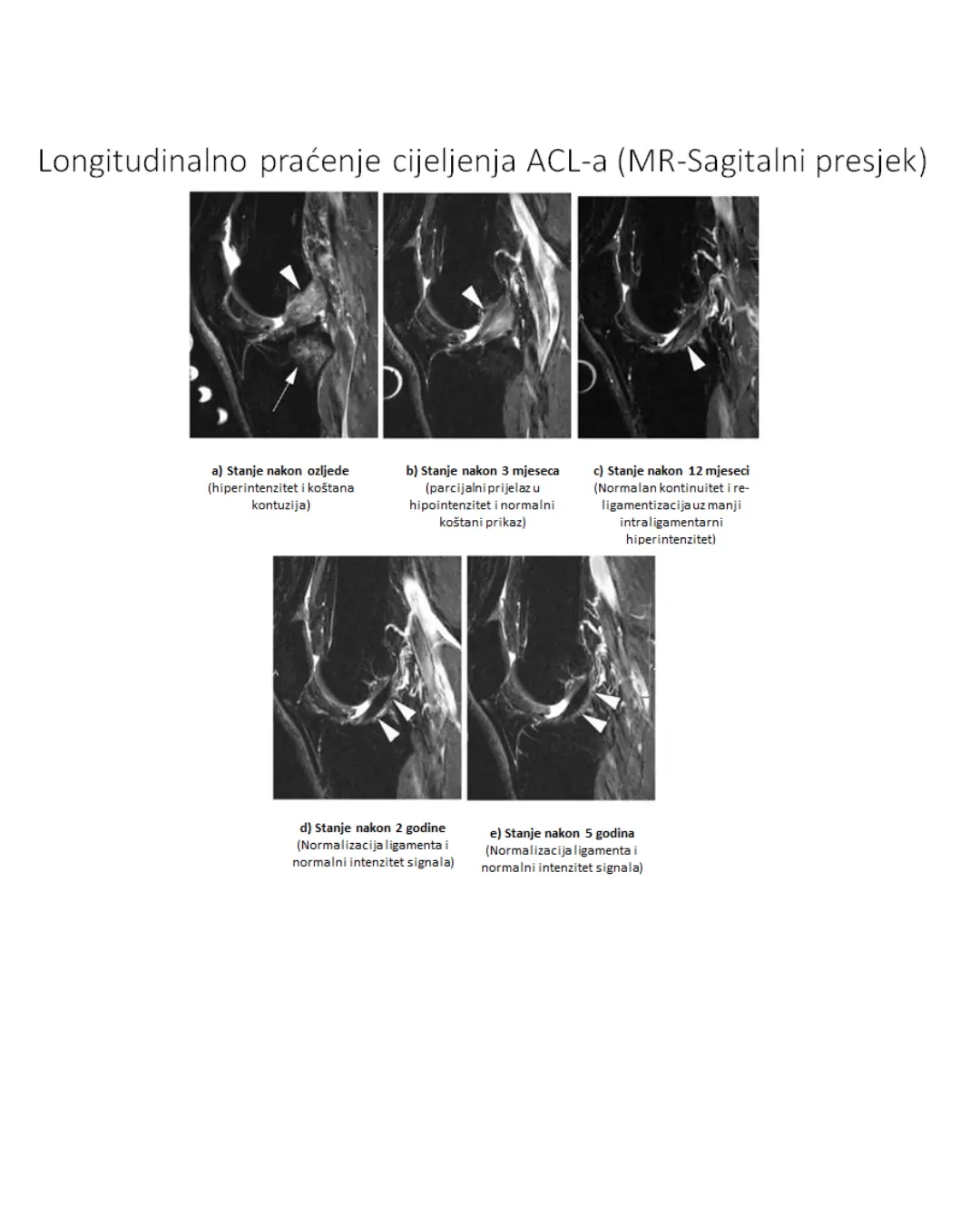 MR prikaz cijeljenja ACL-a kod neoperativne rehabilitacije