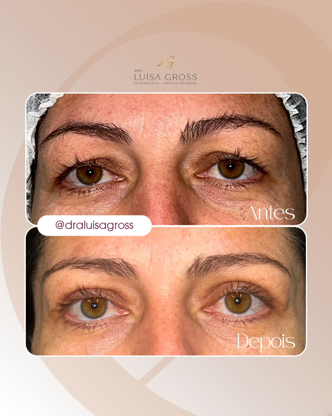 Antes e depois de cirurgia periocular realizada pela Dra. Luisa Gross