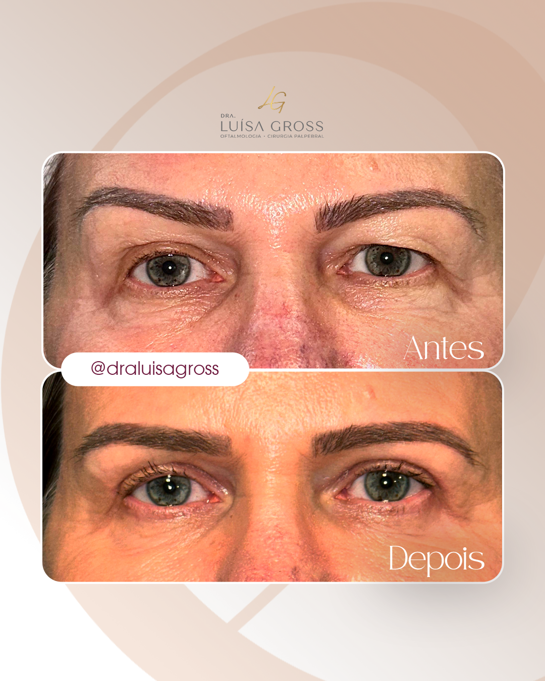 Antes e depois de cirurgia periocular realizada pela Dra. Luisa Gross