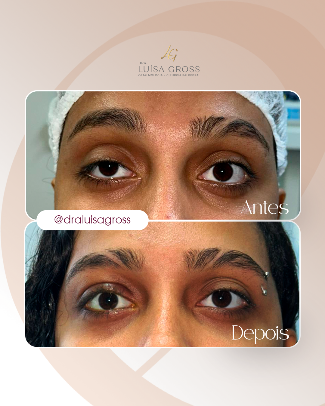 Antes e depois de cirurgia periocular realizada pela Dra. Luisa Gross