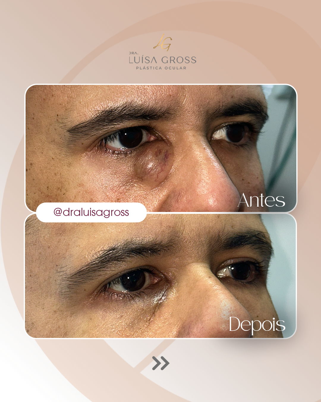Antes e depois de cirurgia periocular realizada pela Dra. Luisa Gross