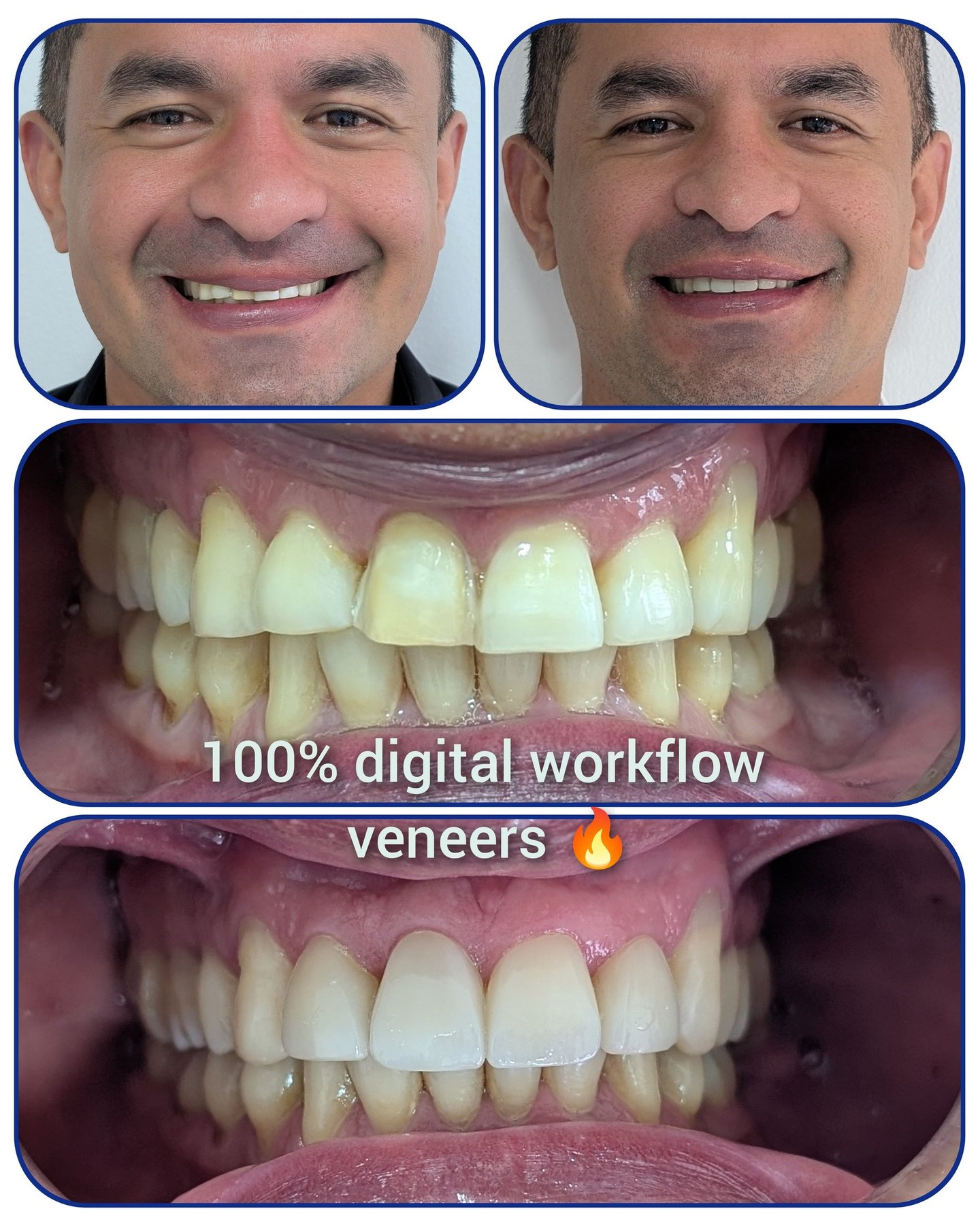 natural dental veneers