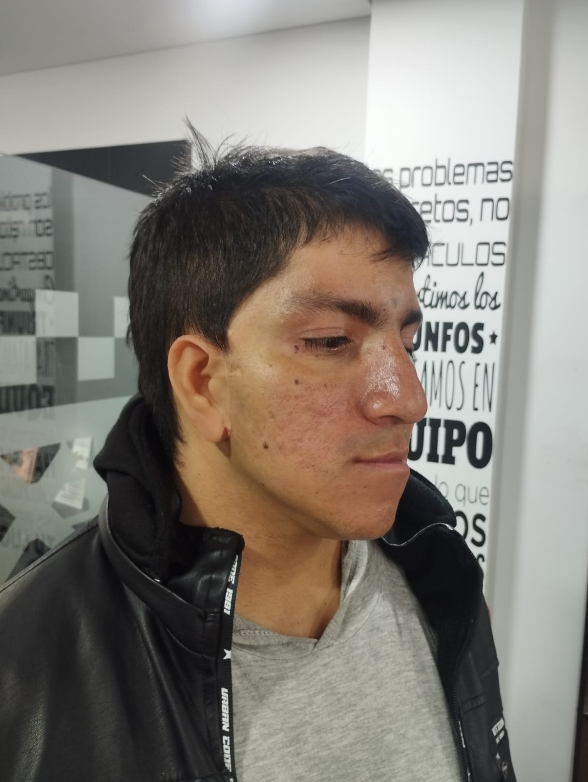 Protesis para orjas en silicona fabricada por anaplastologo clinico