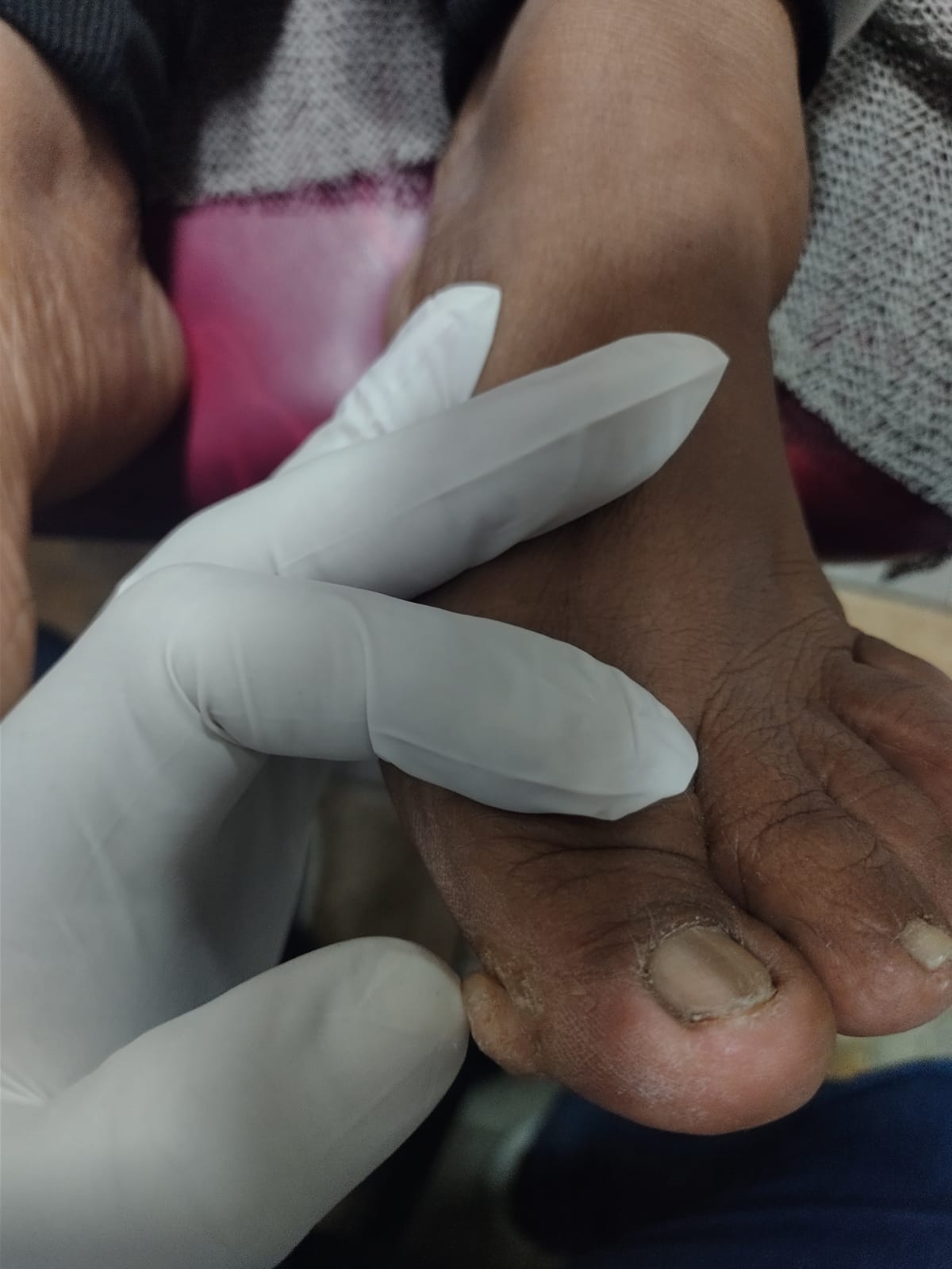 fibroqueratoma digital 