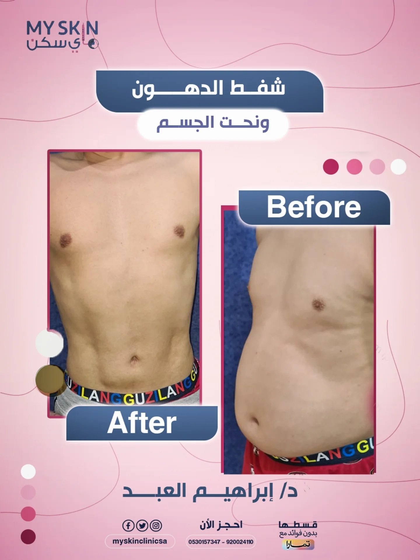 نتيجة شفط وشد البطن مع الاستشاري الدكتور ابراهيم العبد