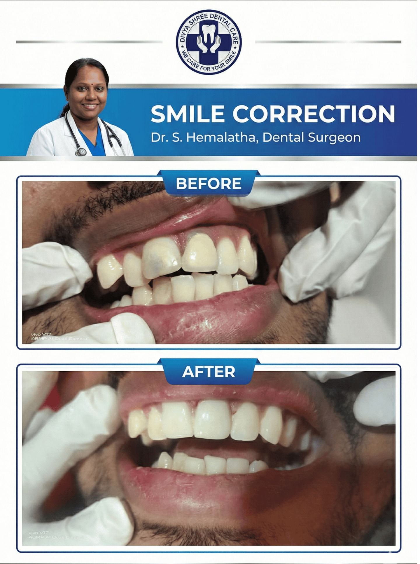Smile Correction before and after results at Divya Shree Dental Care in HSR Layout