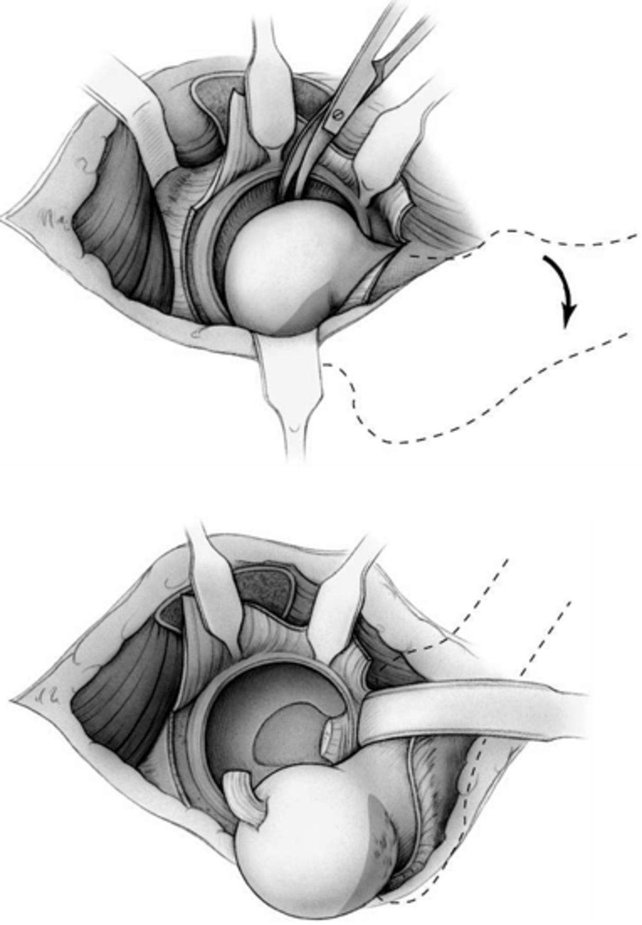 Luxação cirúrgica do quadril.