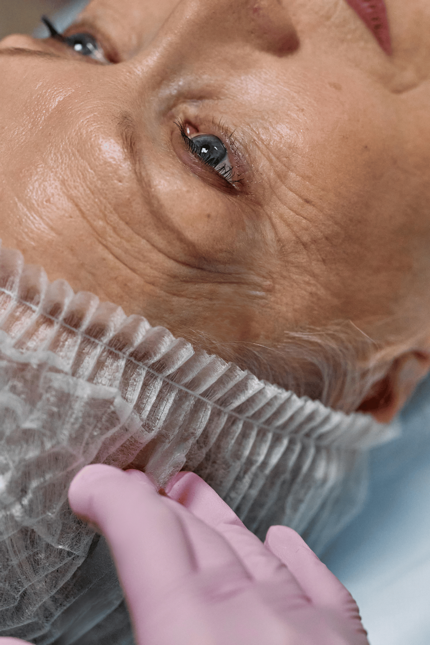 Blefaroplastia