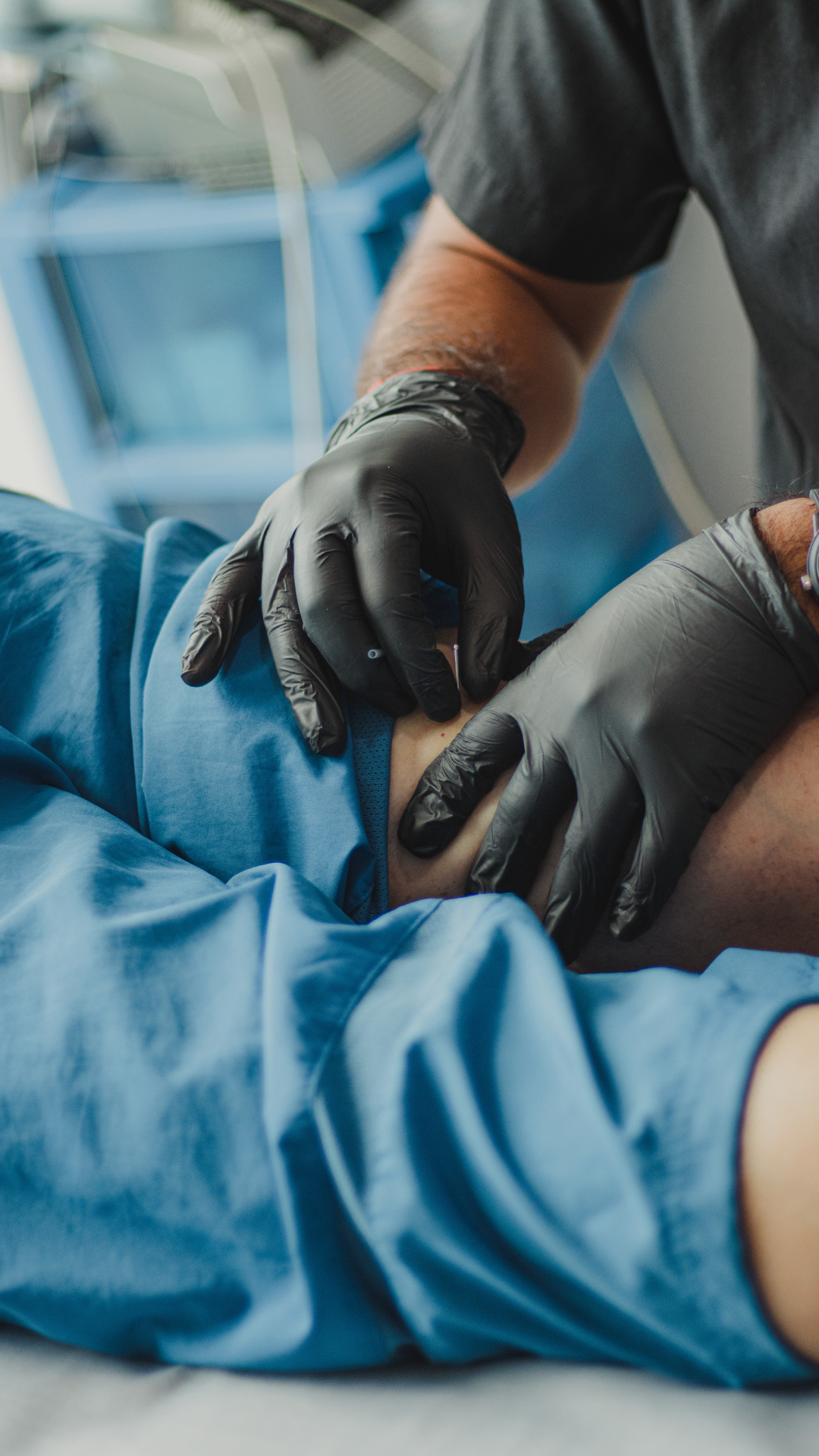 Acupuncture and Dry Needling for Pain Relief at Home