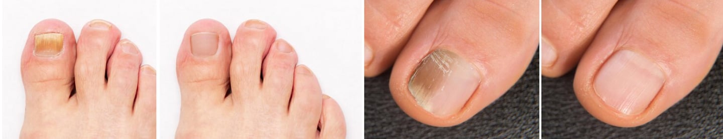 onicomicosis