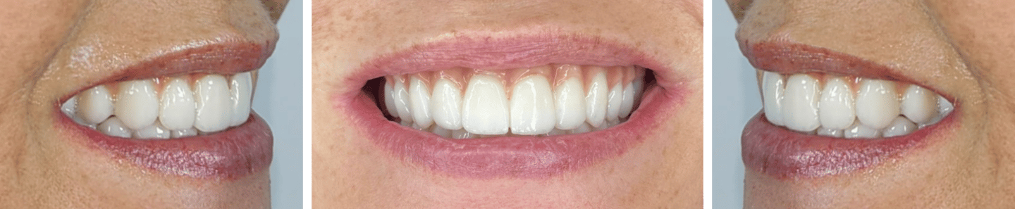 Fixed zirconia bridges for the All on 4 procedure