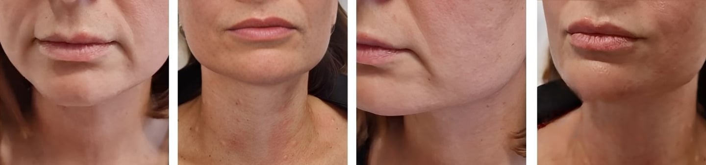 nefertiti lift prima dopo medicina estetica nina gaidau trento verona bolzano