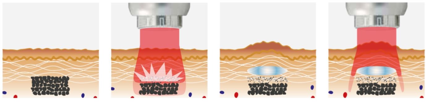 laser tattoo removal diagram singapore