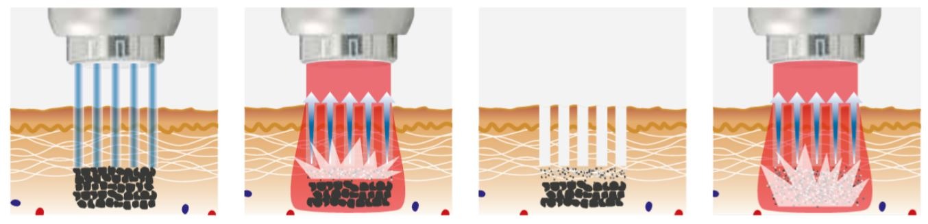 Fotona FracTAT laser tattoo removal singapore