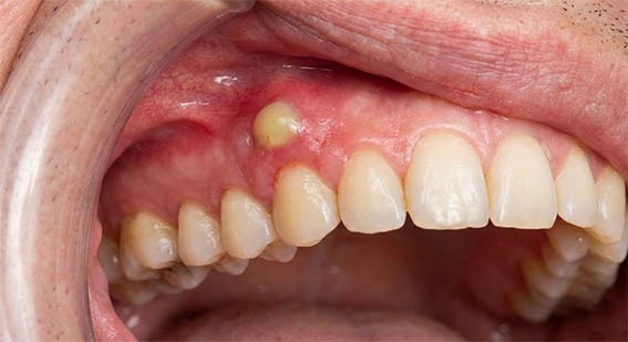 Abcès dentaire : gonflement jaune sur la gencive supérieure près d'une dent.