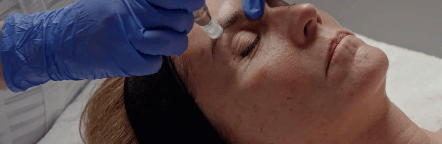 Soin du visage Anti-Age par Nanoneedling et vitamines