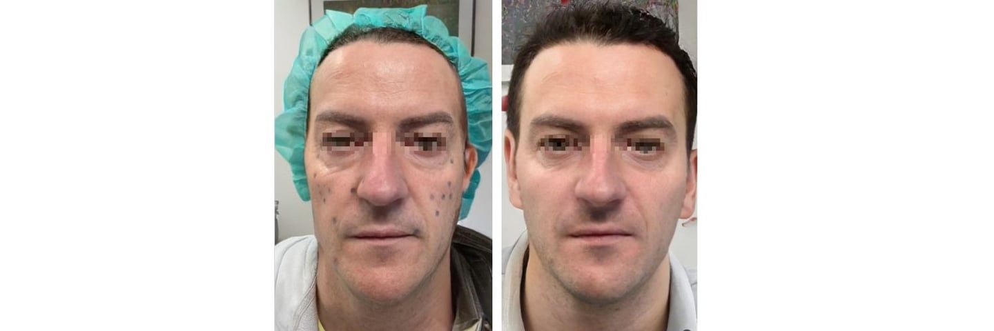 full face medicina estetica prima dopo nina gaidau rovereto trento verona bolzano