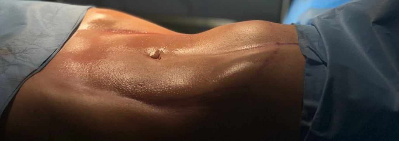 uma mulher com abdômen definido e descoberto com contorno corporal incrível da lipoaspiração