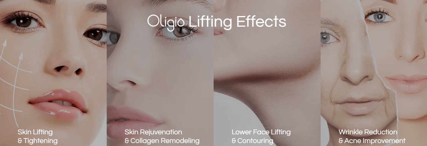 Oligio Monopolar Radiofrequency (RF) Skin Tightening