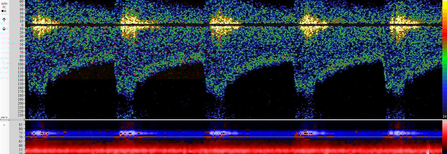 Transcranial Doppler TCD waveforms bruit vasospasm