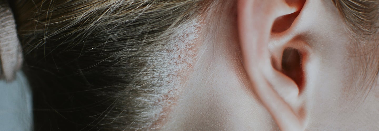 psoriasis en cuero cabelludo en mujer con escamas y eritema detras de la oreja