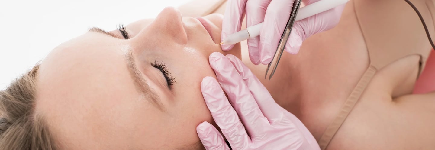 Permanent hair removal with electrolysis - Electrolysis By Misty