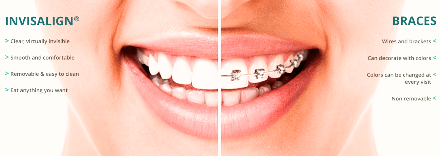 Invisalign near me