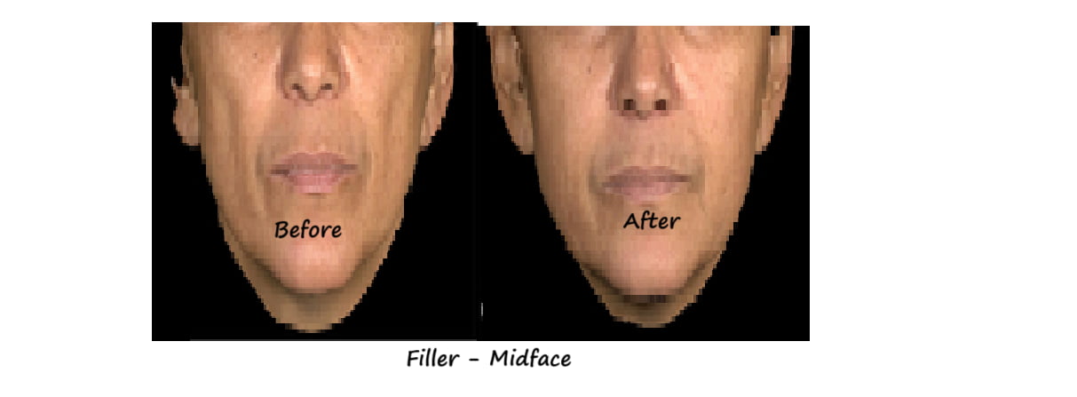 Before & after image fillers cheeks – restored volume, improved contour and natural fullness.