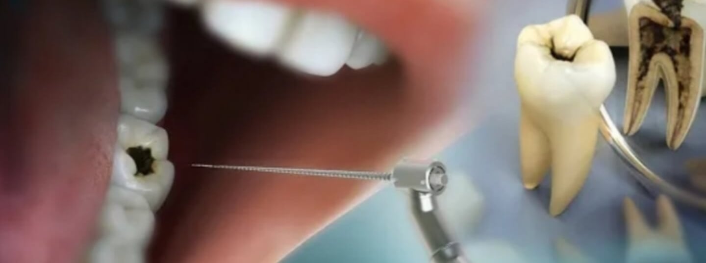 Root Canal Treatment in Greater Noida