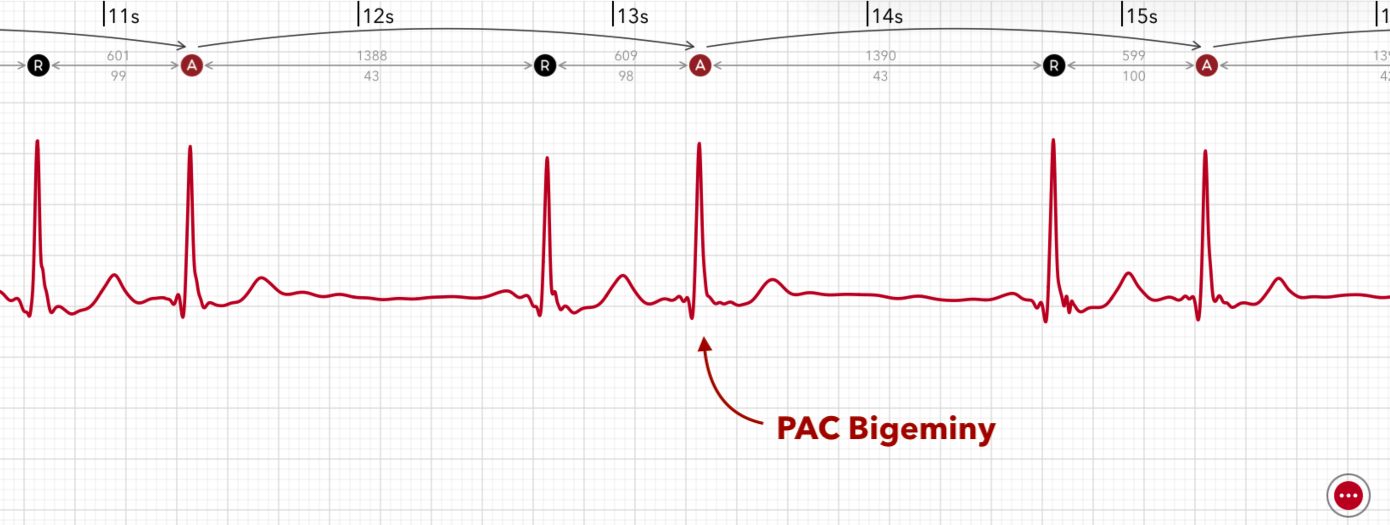A PAC Bigeminy pattern is marked on an Apple Watch ECG report in ECG+