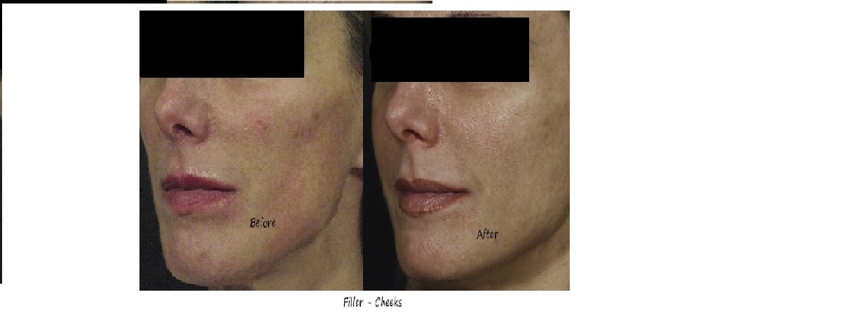 Before & after image filler mid face – improved ogee curve, even skin tone and more radiance.