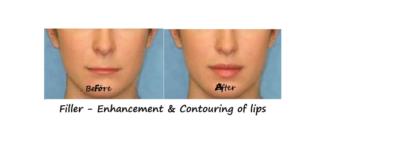 Before and after photos filler lips – increased volume, better contour and harmonious face. 