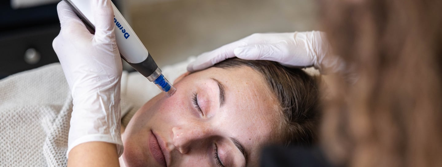 a woman is getting a microneedling treatment at a salon