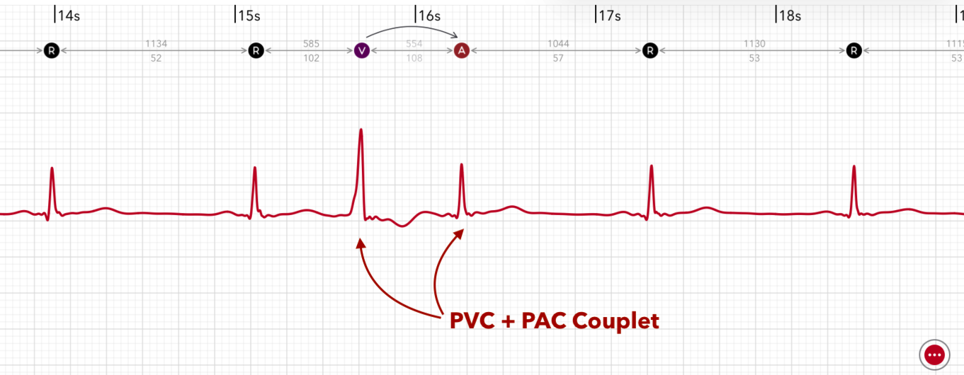 A couplet pattern of PAC + PVC is marked on an Apple Watch ECG report in ECG+