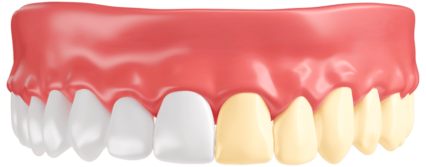 blanqueamiento dental desde 90 euros en las palmas de gran canaria