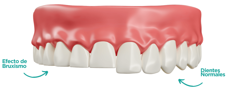 Tratamientos para el bruxismo en  las palmas de Gran Canaria