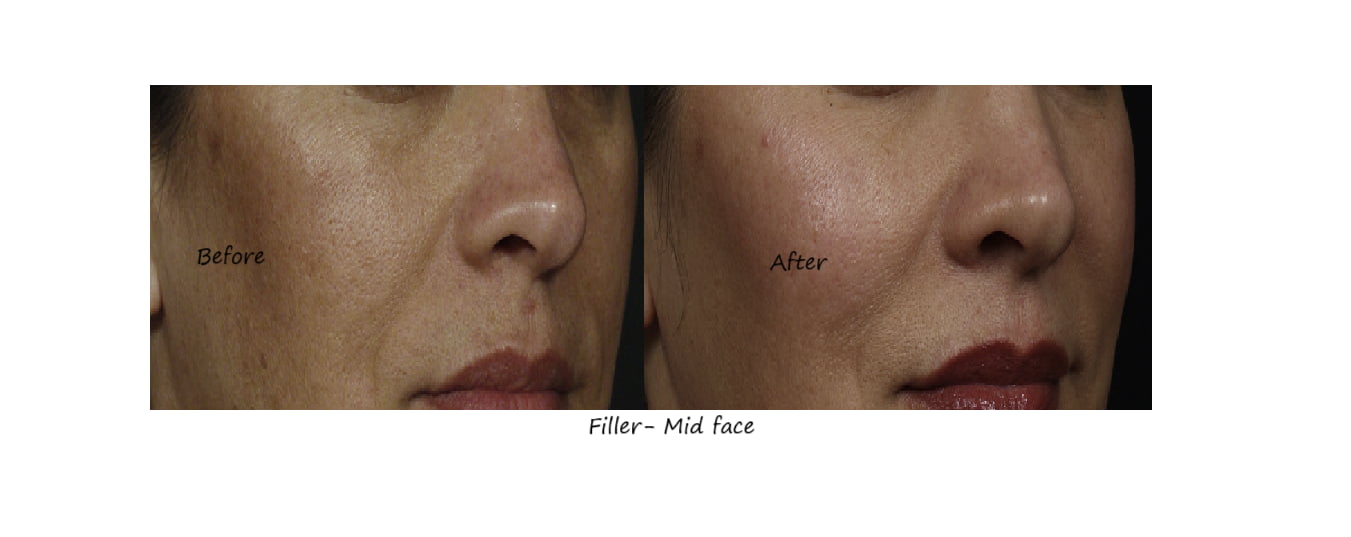 Before & after image fillers cheeks – restored volume, improved contour and natural fullness.