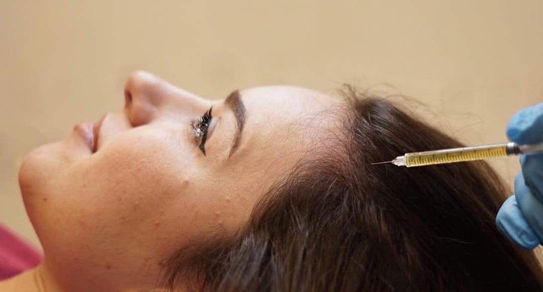 female hair transplant Algeria, male pattern baldness treatment, beard transplant, clinique turque