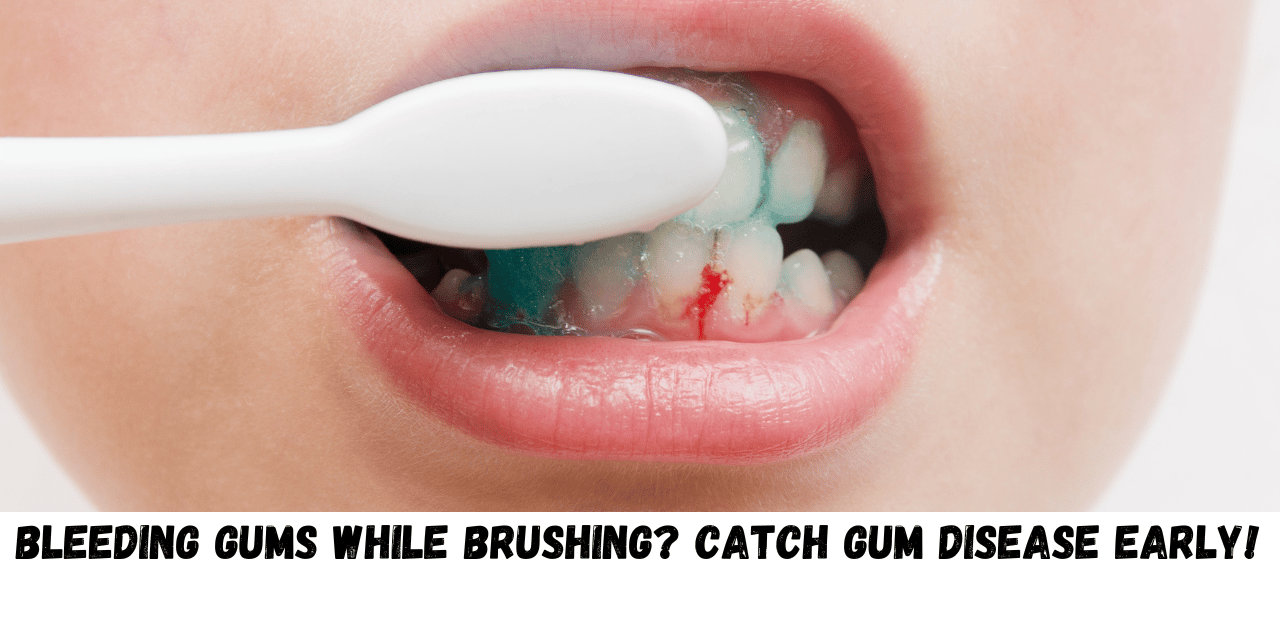 Bleeding Gums