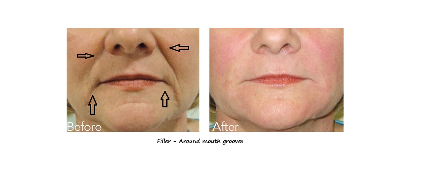 Before and after photos filler around the mouth – reduced groves, smoother contours and younger look