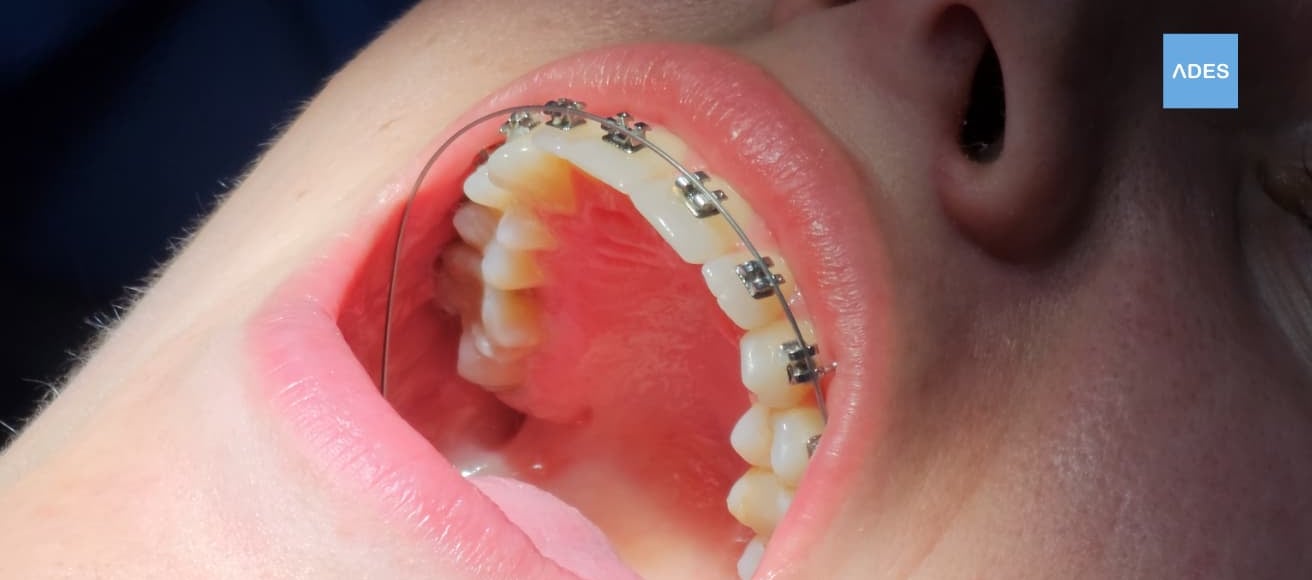 brackets metalicos badajoz