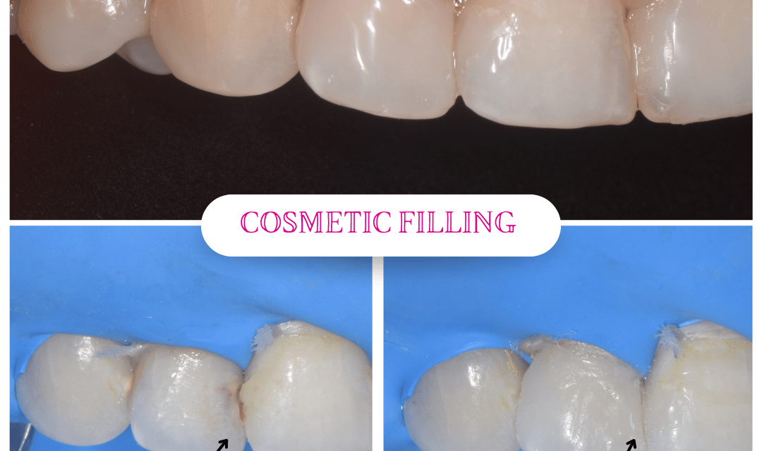 Front tooth cavity treated with Tooth coloured filling done by best cosmetic dentist in Malad Mumbai