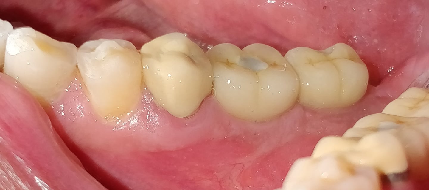 missing teeth replaced with dental implants by best implantologist in malad west mumbai