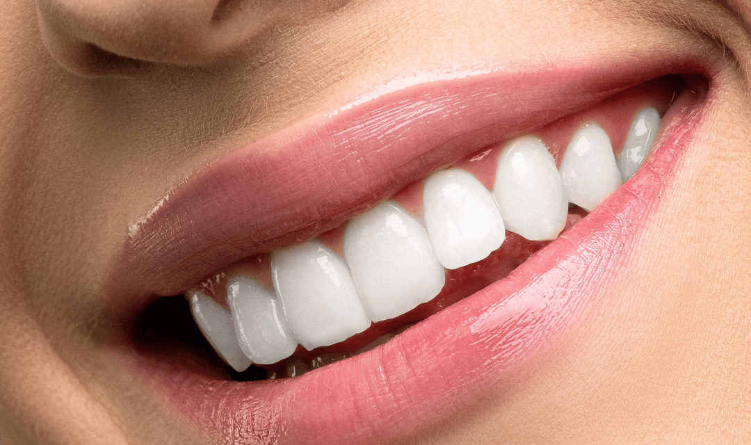 White straight teeth after teeth whitening at best dental clinic in Orlem Malad west Mumbai