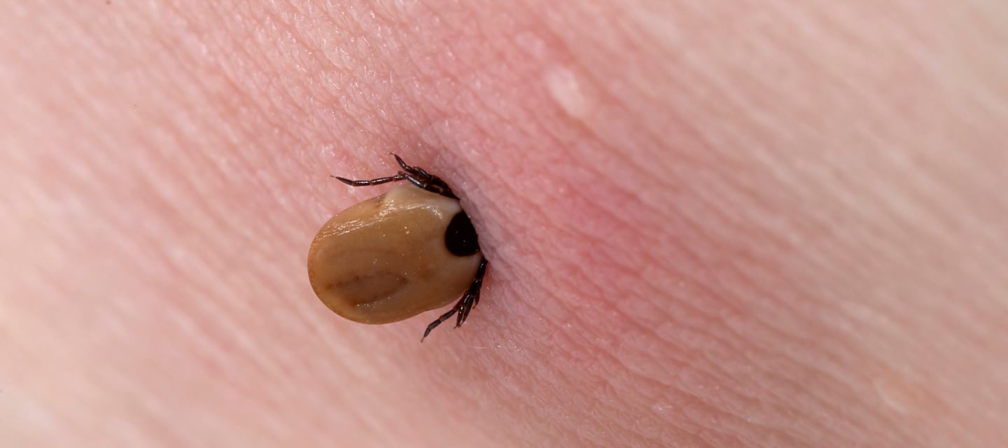 tick bite on skin
