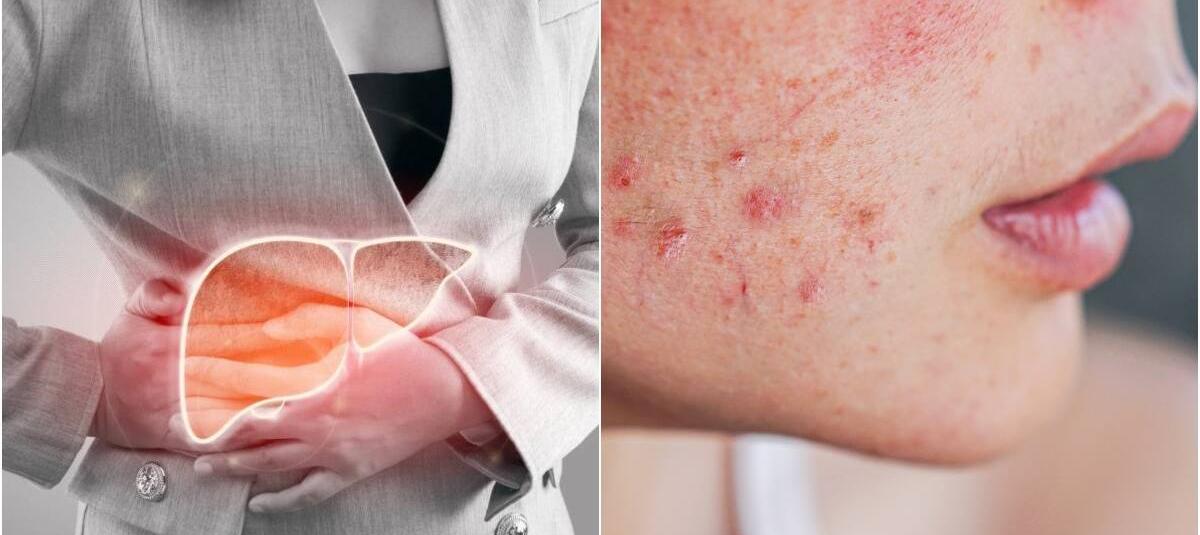 Señales de Hígado Graso en la Piel: Lo que tu Cuerpo te Está Diciendo