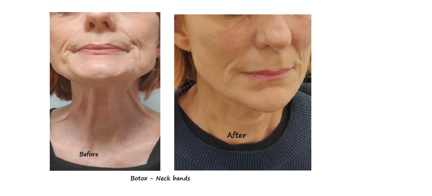 Before and after photos of Botox in the neck with reduced neck bands and a more youthful appearance.